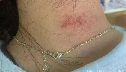 重金属超标！女子戴项链引发“首饰病”