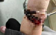 女子手镯10年没摘竟“长”进肉里！医生：再迟就保不住了