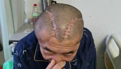 男子右脑出血，手术时被开错左脑！家属提300万元赔偿被拒，当地卫健委回应